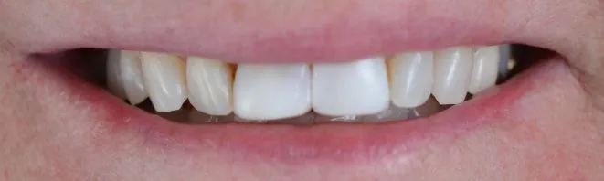 Smile Gallery full front view smile before