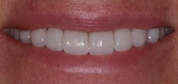 Smile Gallery full front view smile after