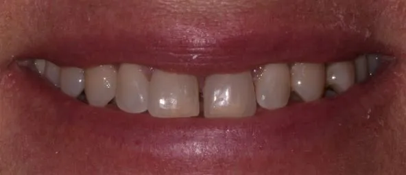 Smile Gallery full front view smile before