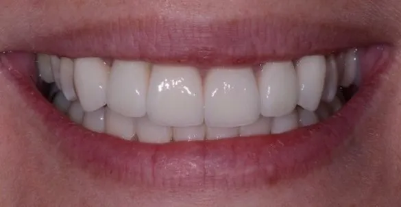 Smile Gallery full front view smile after