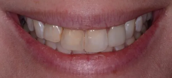 Smile Gallery full front view smile before