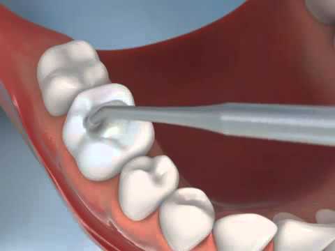 Middletown RI Dentist Shares Video Animation of Composite Tooth Colored Filling Video Thumbnail